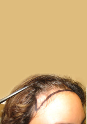 hair transplant before after Photos