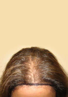 hair transplant photos