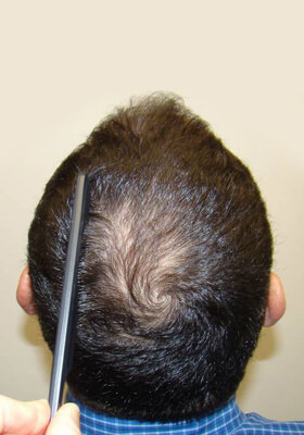 hair transplant photos