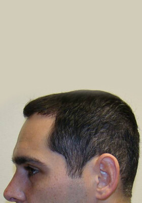 hair transplant photos