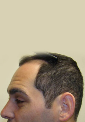 hair transplant photos