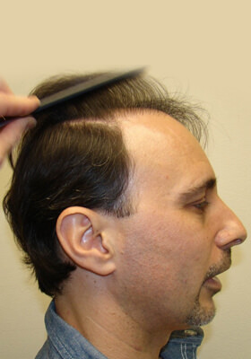 hair transplant photos