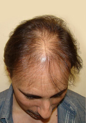 hair transplant photos