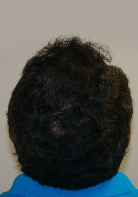 hair transplant before after Photos