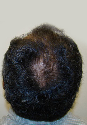 hair transplant photos