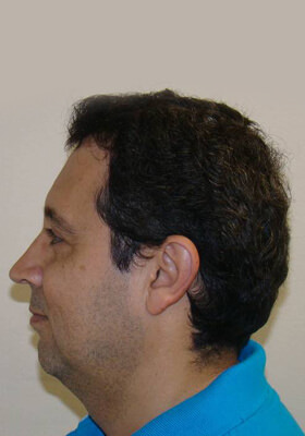 hair transplant photos