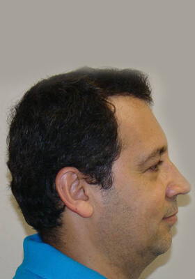 hair transplant before after Photos