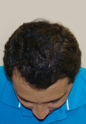 hair transplant photos