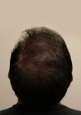 hair transplant before after Photos