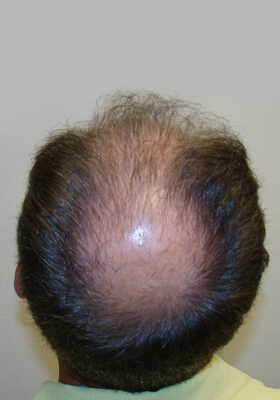 hair transplant photos