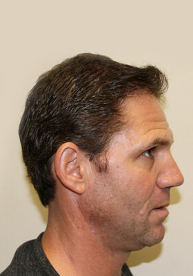 hair transplant photos