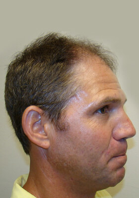 hair transplant before after Photos