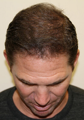 hair transplant before after Photos