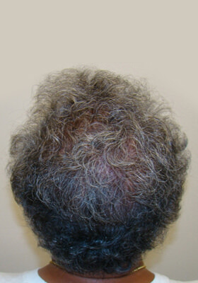 hair transplant photos