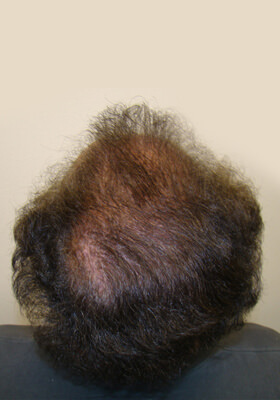 hair transplant before after Photos