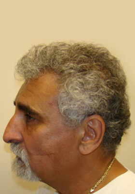 hair transplant photos