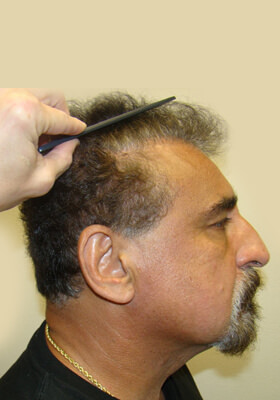 hair transplant photos