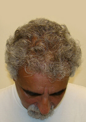 hair transplant photos