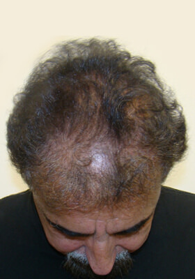 hair transplant photos