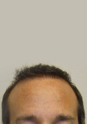 hair transplant before after Photos