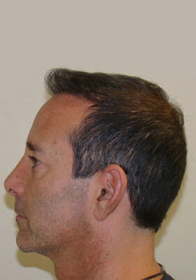 hair transplant before after Photos