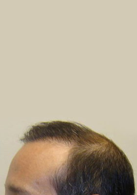 hair transplant before after Photos