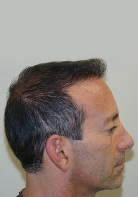 hair transplant before after Photos