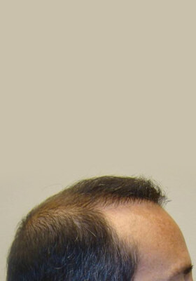 hair transplant photos