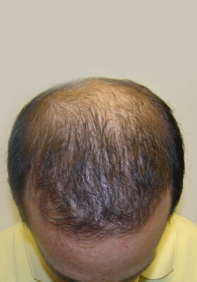 hair transplant photos