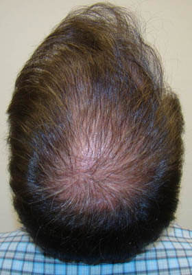 hair transplant photos