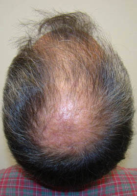 hair transplant photos