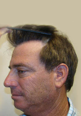 hair transplant photos