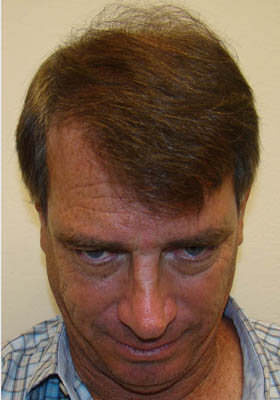 hair transplant photos