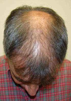 hair transplant before after Photos