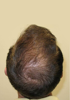 hair transplant before after Photos