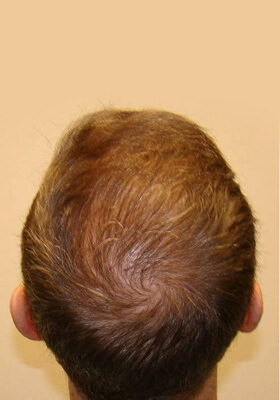 hair transplant photos