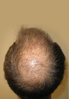 hair transplant before after Photos