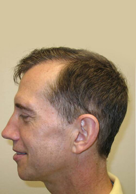 hair transplant before after Photos