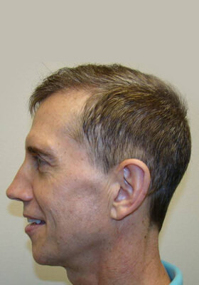 hair transplant photos