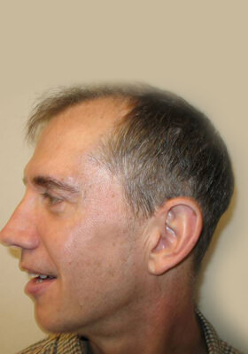 hair transplant before after Photos