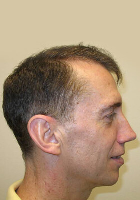 hair transplant before after Photos