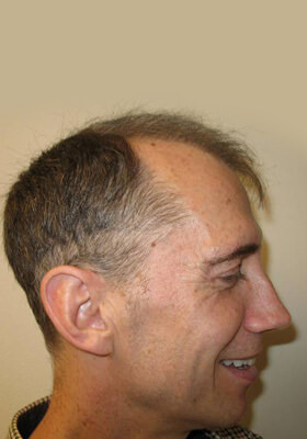 hair transplant photos