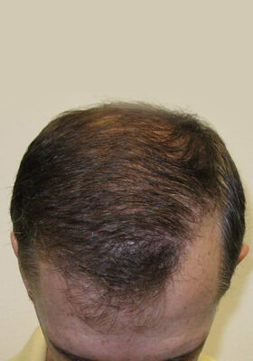 hair transplant before after Photos