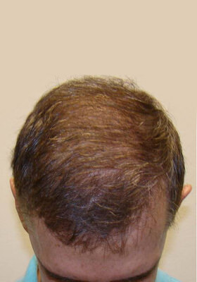 hair transplant photos