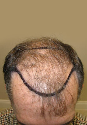 hair transplant photos