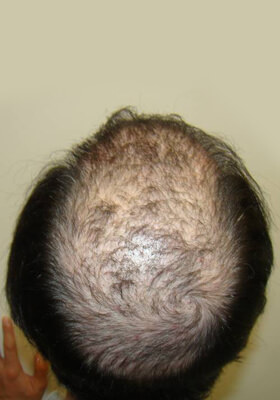 hair transplant photos