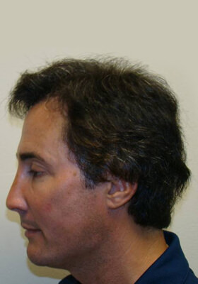 hair transplant photos