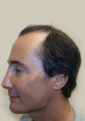 hair transplant photos