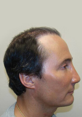 hair transplant photos