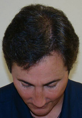 hair transplant before after Photos